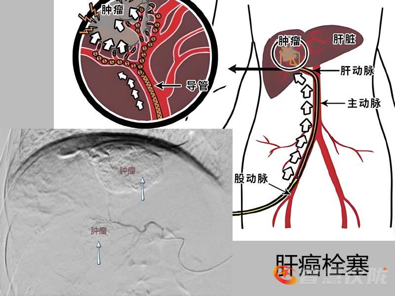 为什么要用到微导管医疗科普｜外周与综合介入：用最小创伤，护你全身健康