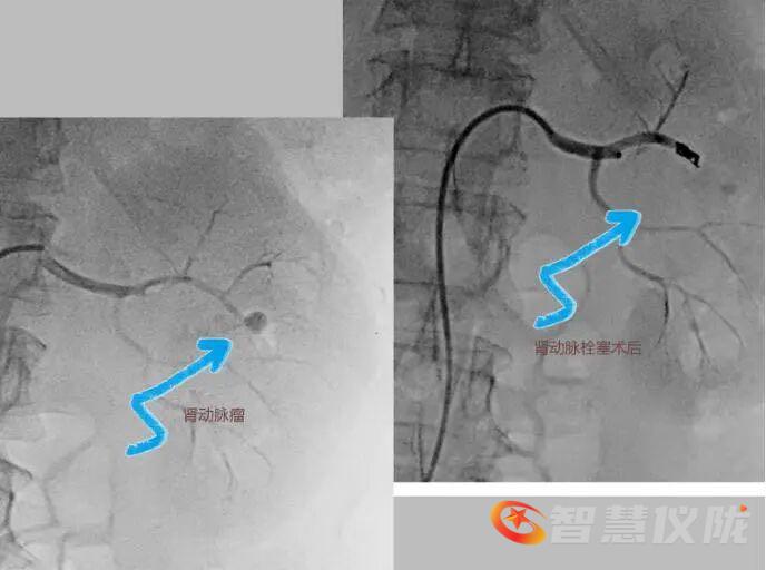 为什么要用到微导管医疗科普｜外周与综合介入：用最小创伤，护你全身健康_https://www.jmylbn.com_新闻资讯_第2张