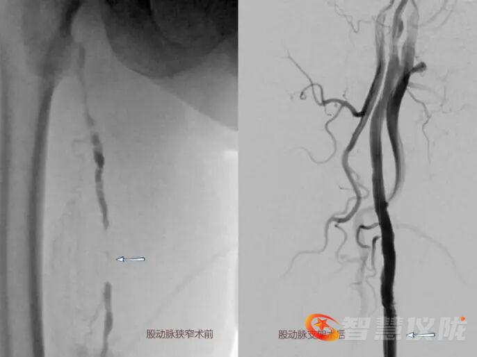为什么要用到微导管医疗科普｜外周与综合介入：用最小创伤，护你全身健康_https://www.jmylbn.com_新闻资讯_第3张